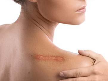 Scar-Treatments